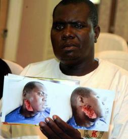 Habila Adamu with pictures showing where he was shot by Boko Haram militants in 2012